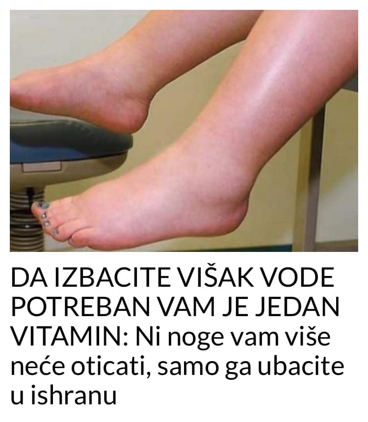 DA IZBACITE VIŠAK VODE POTREBAN VAM JE JEDAN VITAMIN: Ni noge vam više neće oticati, samo ga ubacite u ishranu