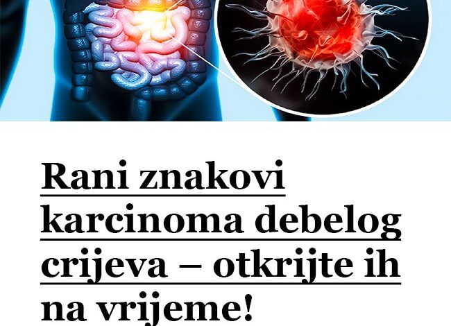 Rani znakovi karcinoma debelog crijeva – otkrijte ih na vrijeme!