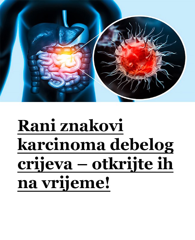 Rani znakovi karcinoma debelog crijeva – otkrijte ih na vrijeme!