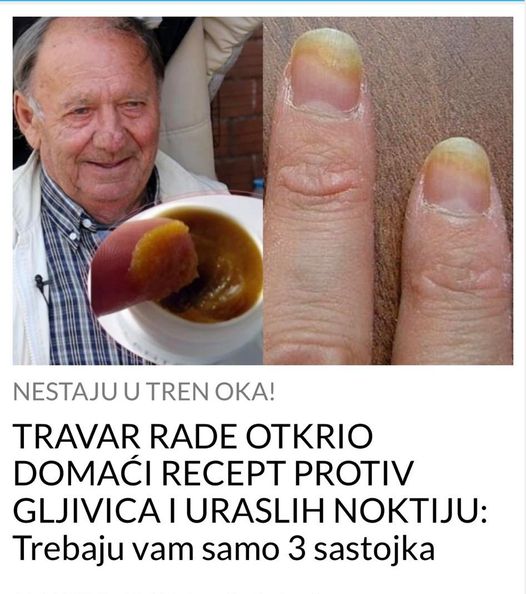 TRAVAR RADE OTKRIO DOMAĆI RECEPT PROTIV GLJIVICA I URASLIH NOKTIJU: Trebaju vam samo 3 sastojka